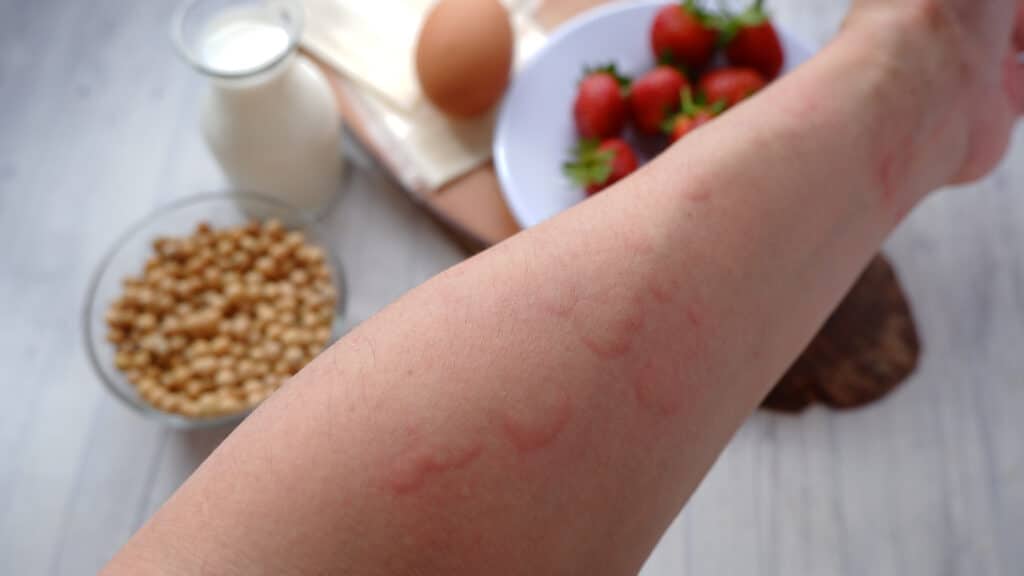 Red raised hives on an arm beside common food allergens including milk, egg, nuts, and strawberries. Red raised hives on an arm beside common food allergens including milk, egg, nuts, and strawberries.
